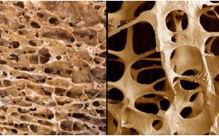 OSTEOPOROSH
