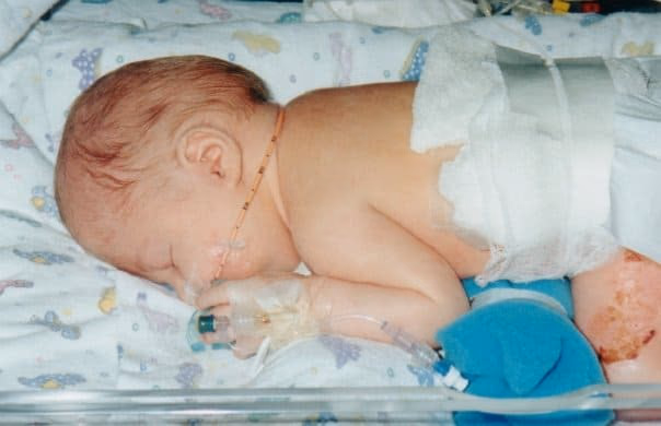 pressured abort spina bifida trisomy 18 trusted 02
